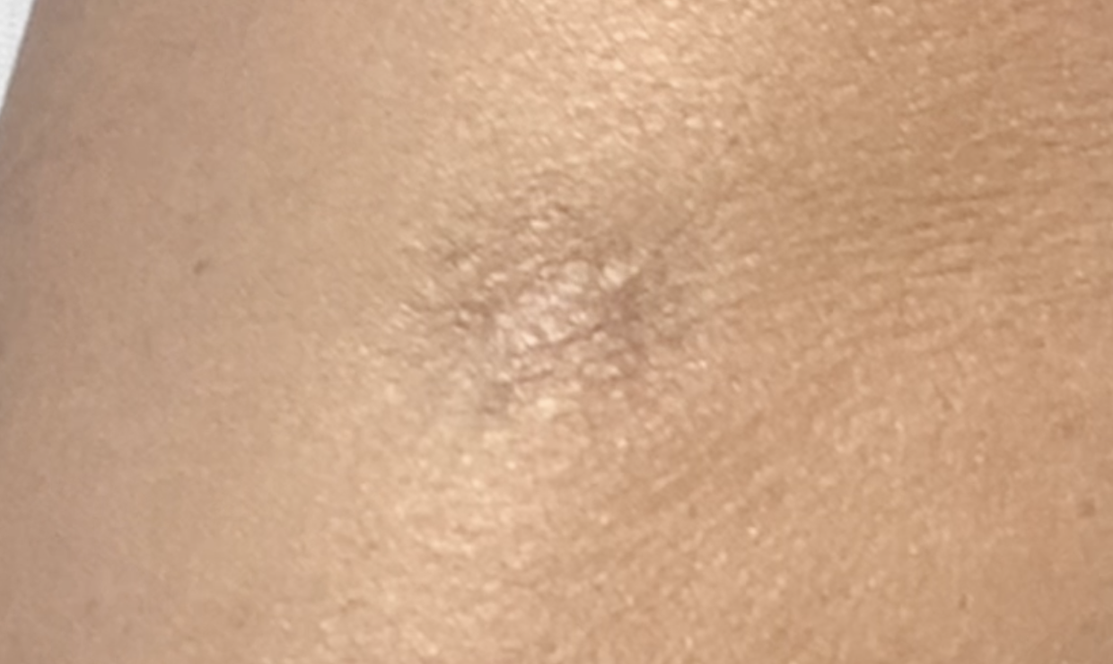 scar after body makeup coverage