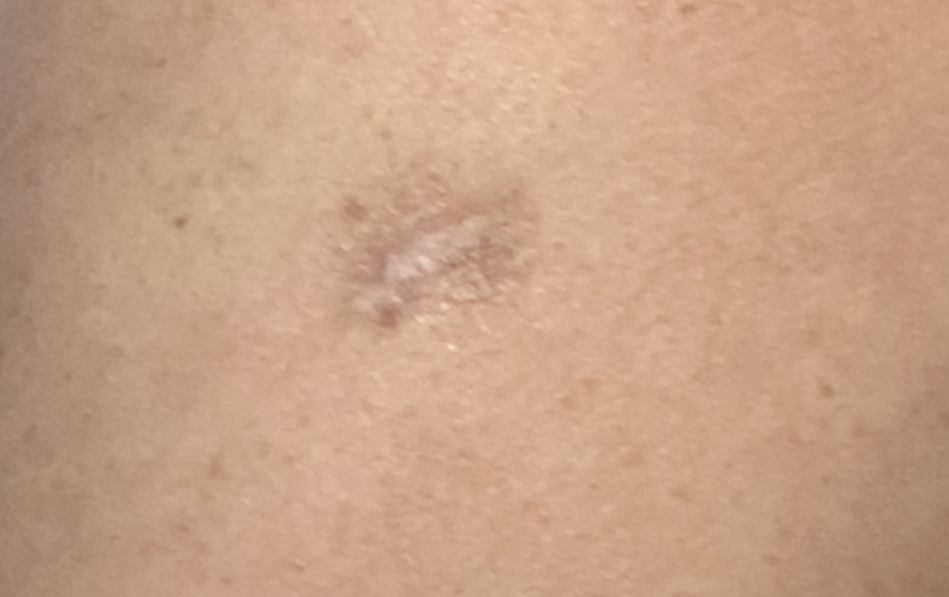 scar before makeup coverage